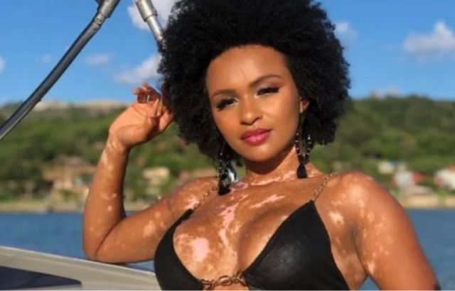 Vitiligo: o que é, causas e possíveis tratamentos