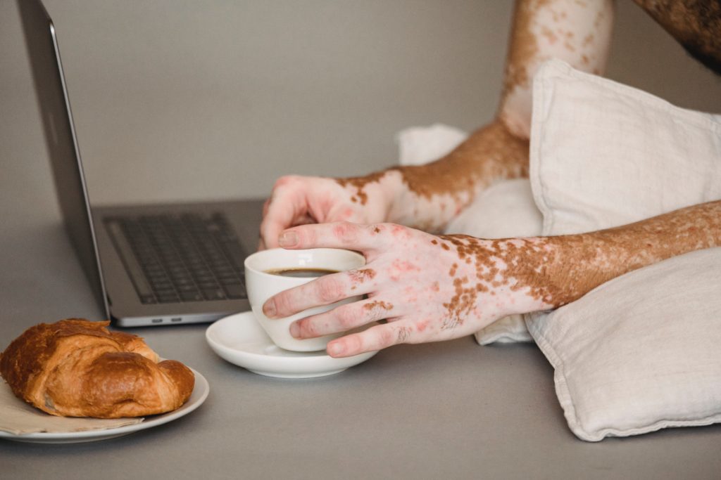 vitiligo